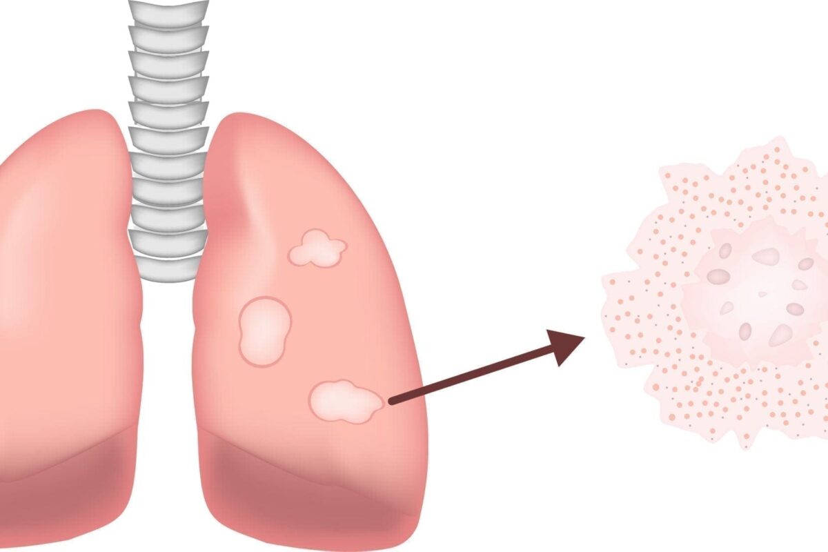 Sarcoidosis