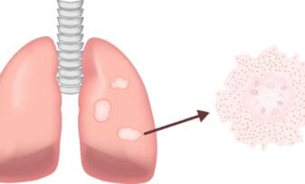 Sarcoidosis