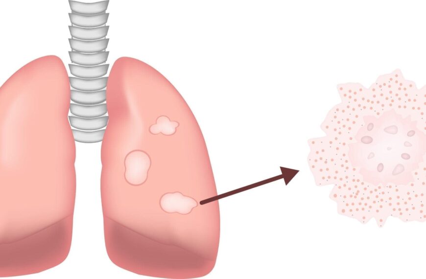 Sarcoidosis