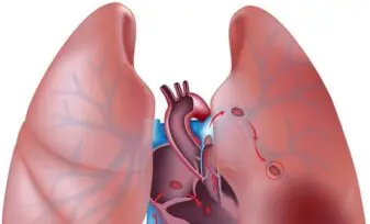 Trombosis de las venas pulmonares después de trasplante pulmonar