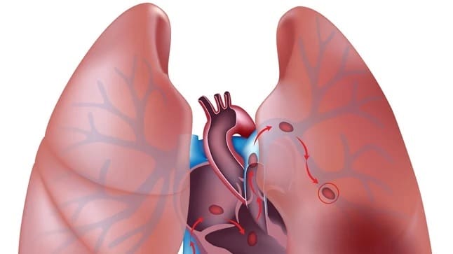 Trombosis de las venas pulmonares después de trasplante pulmonar