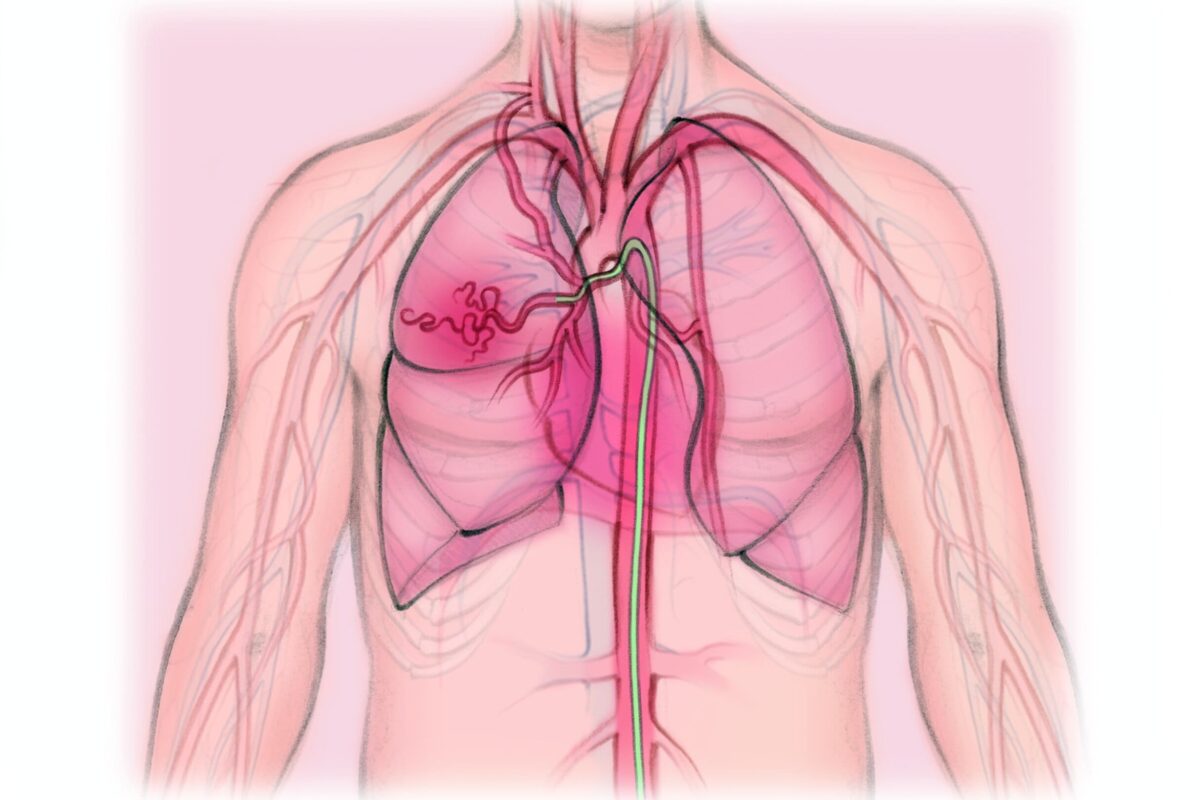 Embolización de las arterias bronquiales