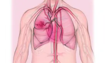 Embolización de las arterias bronquiales