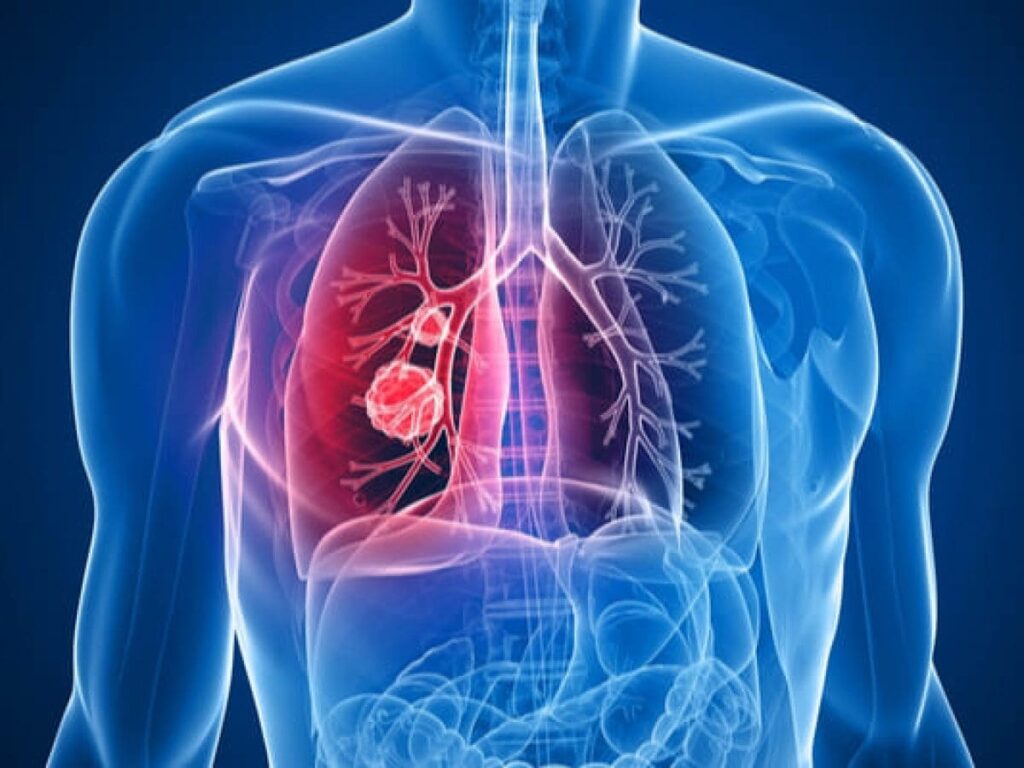 Fisiopatología del tromboembolismo pulmonar