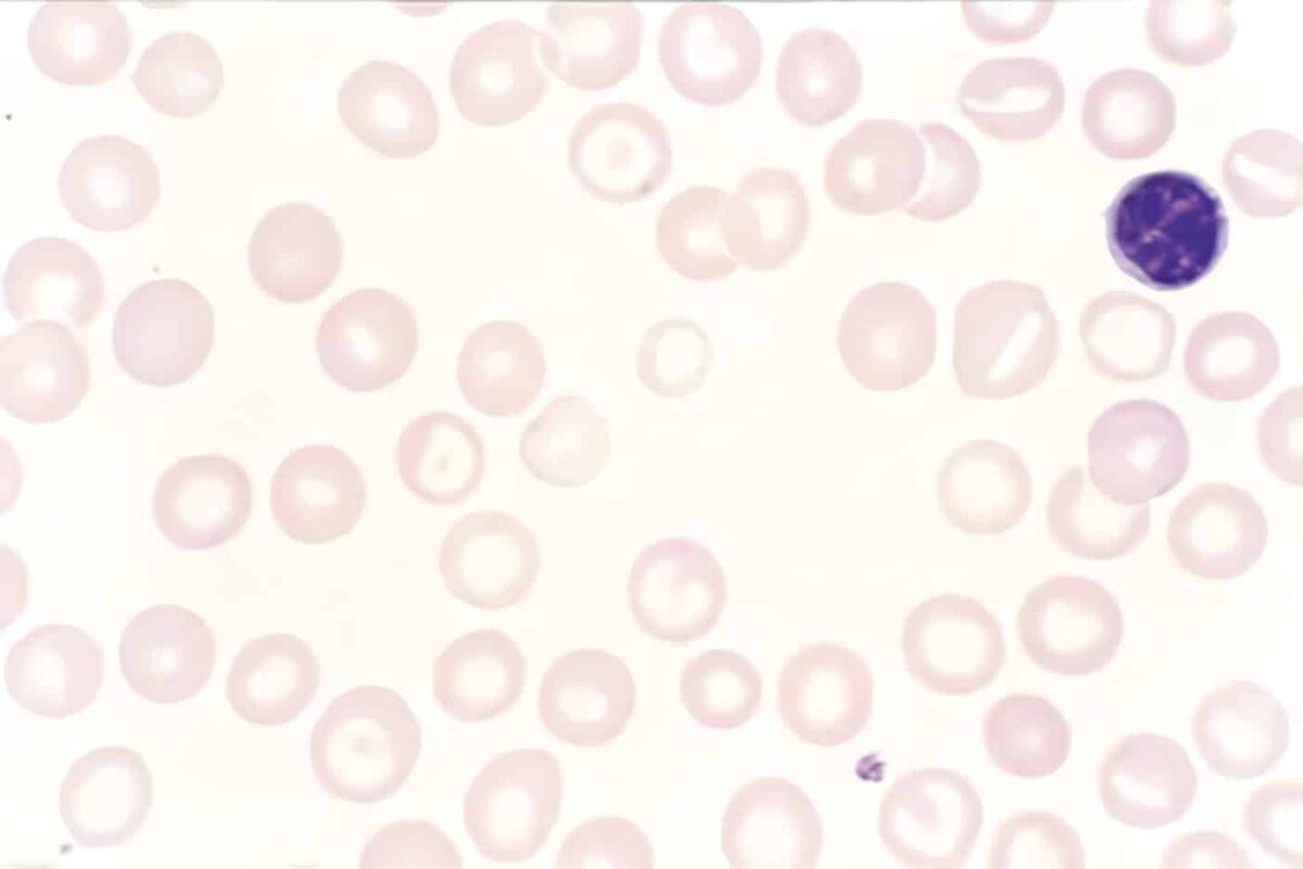 Anemias Microcíticas y Macrocíticas