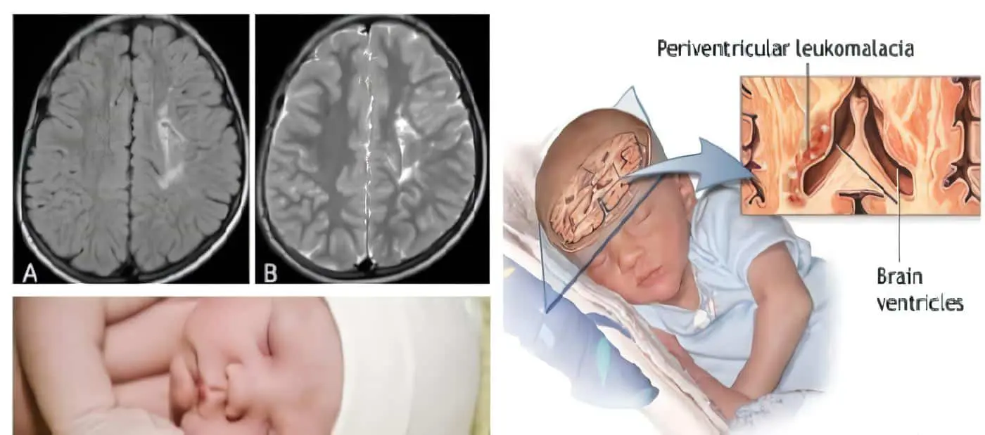 Leucomalacia Periventricular