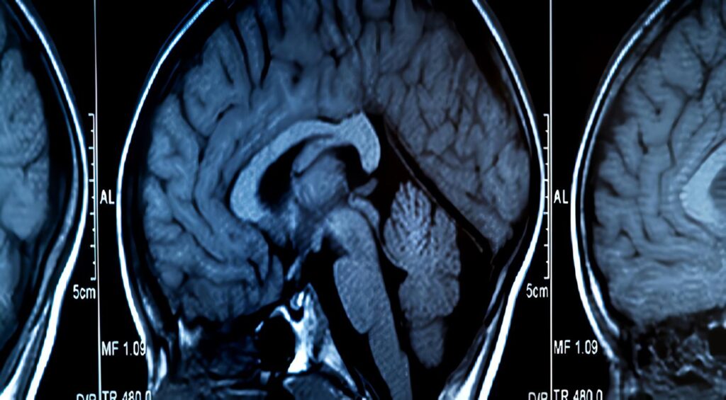 Hemorragia Intracraneana