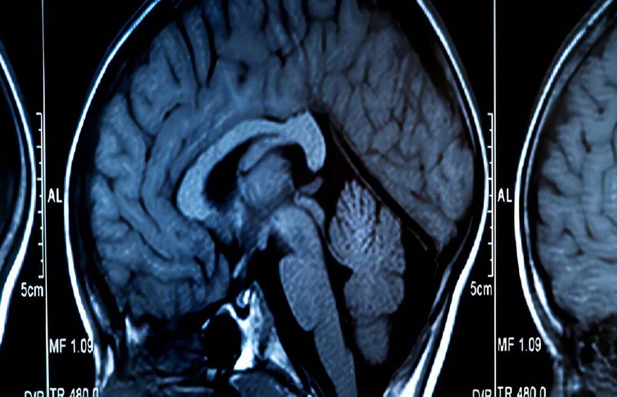 Hemorragia Intracraneana