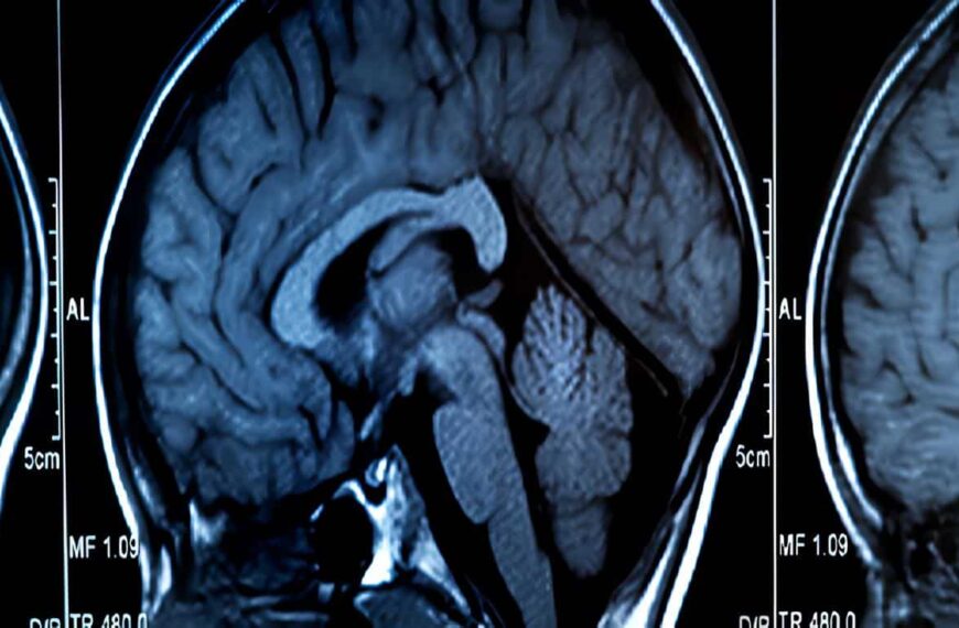 Hemorragia Intracraneana