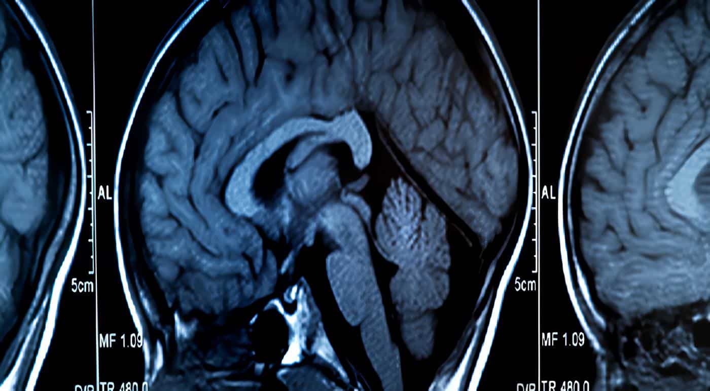 Hemorragia Intracraneana