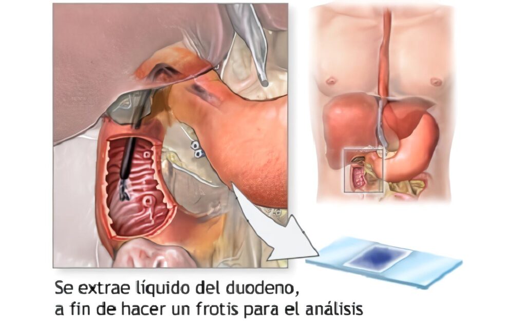 Aspirado Duodenal