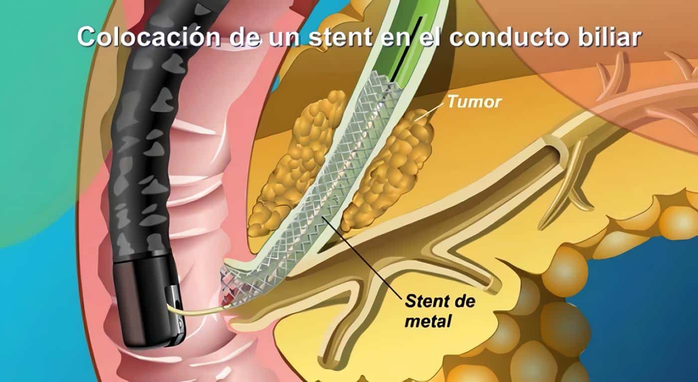 Colangiografía Retrógrada Endoscópica