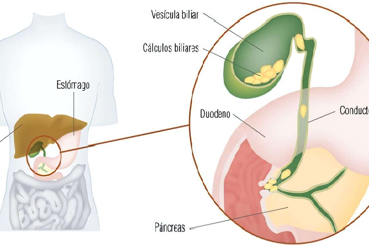 Colecistitis Aguda