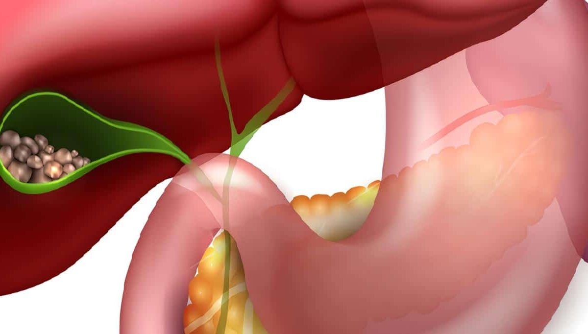 Coledocolitiasis - Colelitiasis