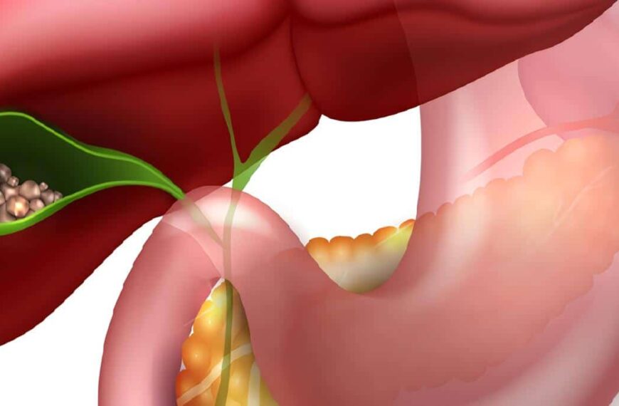 Coledocolitiasis - Colelitiasis