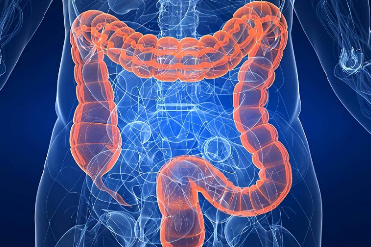 Colitis Isquémica
