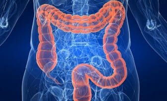 Colitis Isquémica