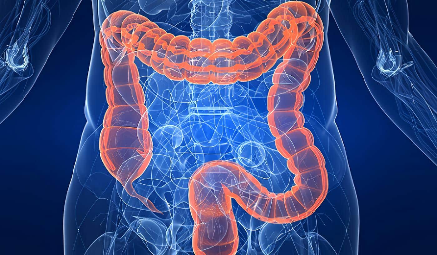 Colitis Isquémica