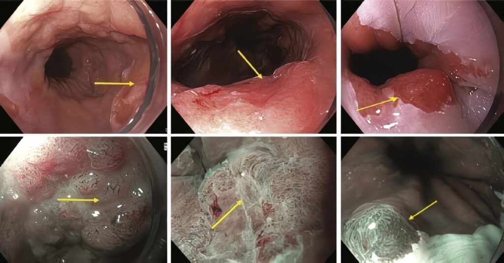 Cromoendoscopia