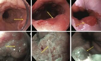 Cromoendoscopia