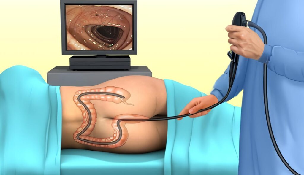 Rectosigmoidoscopia