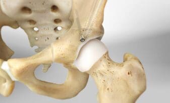 osteotomía periacetabular