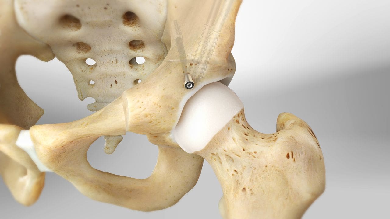 osteotomía periacetabular