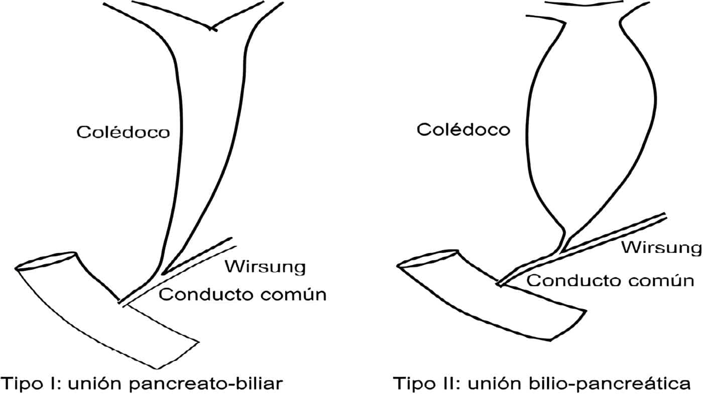 Dilataciones Quísticas Congénitas del Colédoco