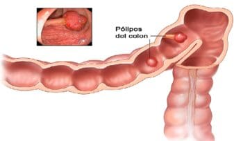 Pólipo Colorrectal Maligno