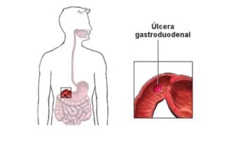 Úlceras Gastroduodenales