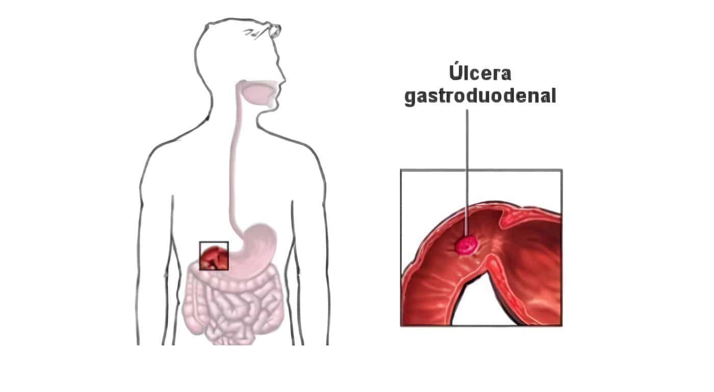 Úlceras Gastroduodenales