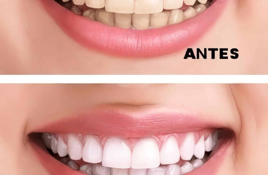 Aclaramiento o Blanqueamiento Dental