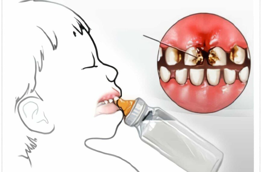 Caries del Lactante