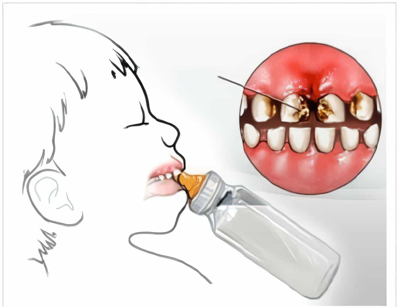 Caries del Lactante