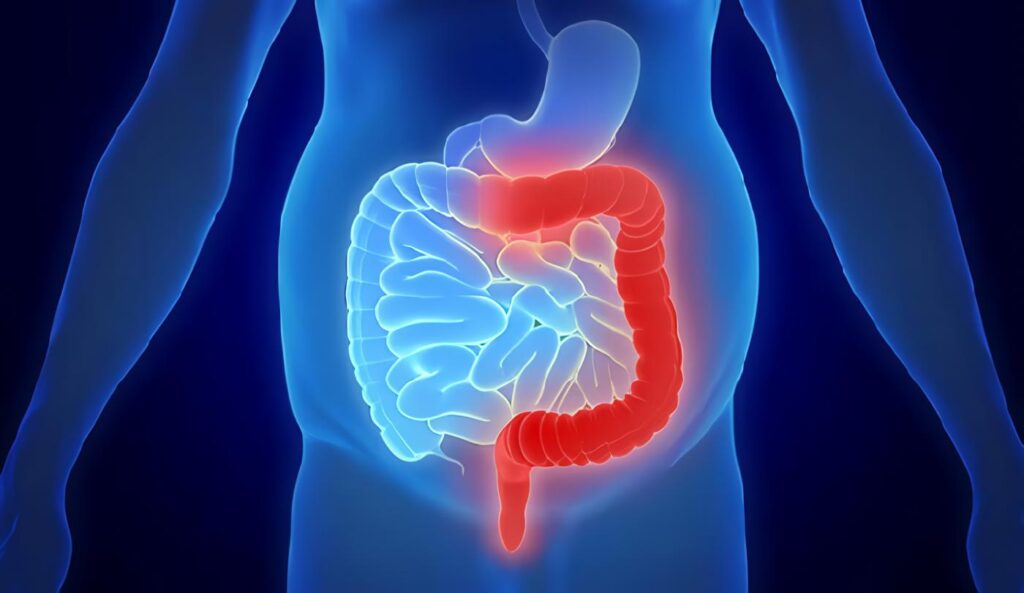 Colitis Ulcerosa