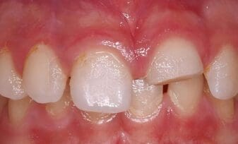 Endodoncia en Trauma Dentoalveolar
