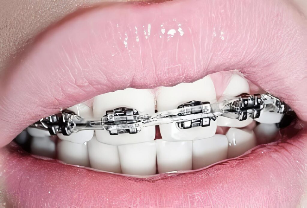 Cubrimiento de Grandes Recesiones Gingivales Localizadas