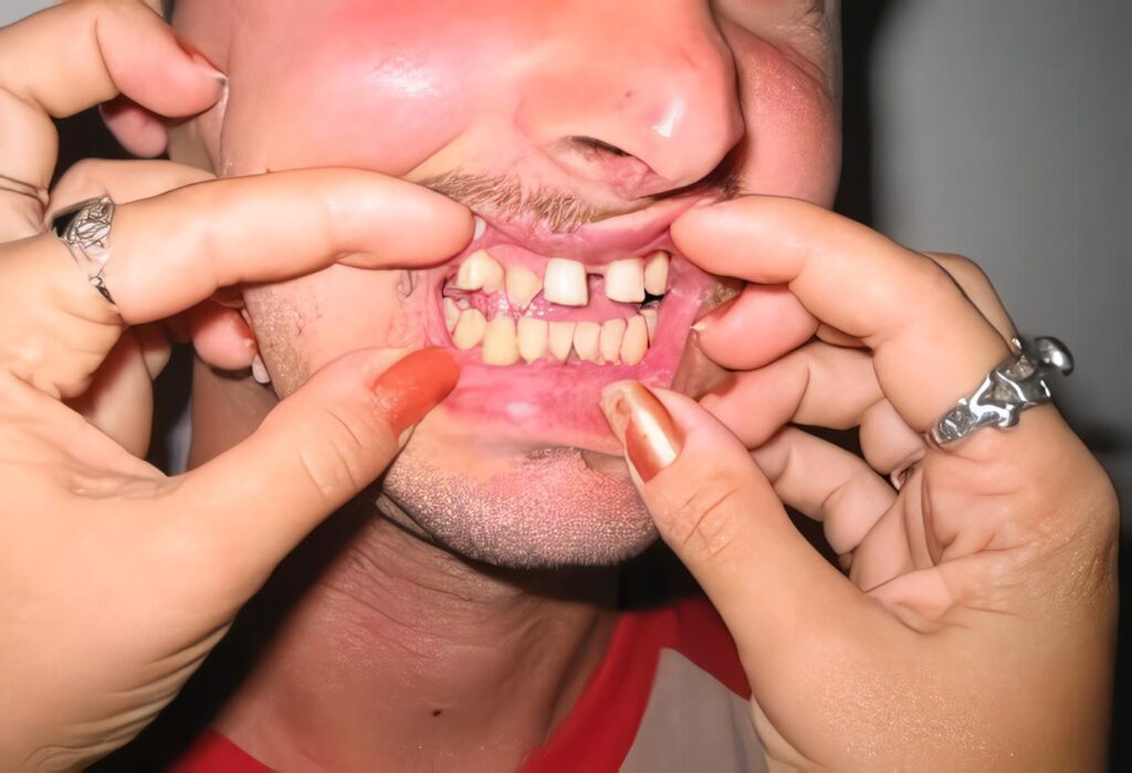 Displasia Ectodérmica Asociada con Retardo en la Exfoliación