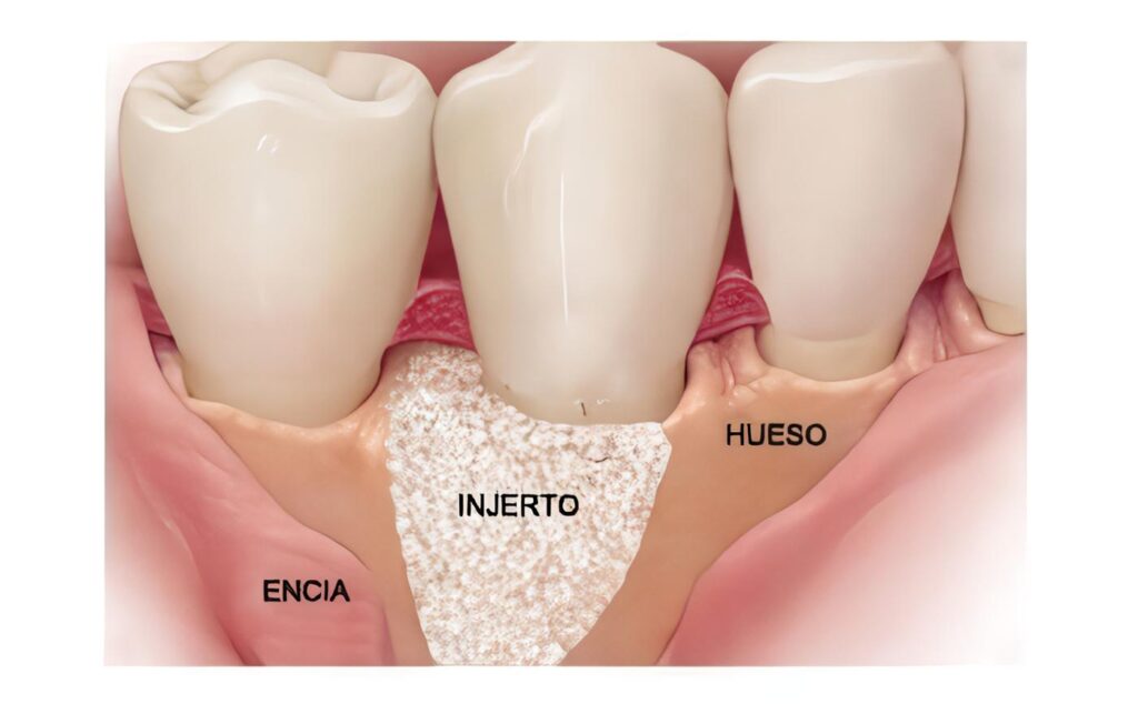 Injertos Óseos Alveolares