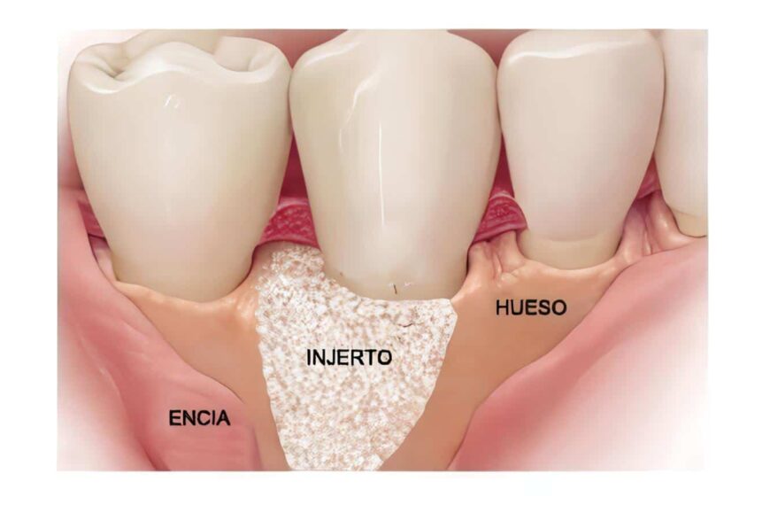 Injertos Óseos Alveolares