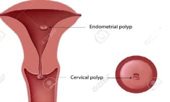 Pólipos Cervicales - Pólipos Endometriales