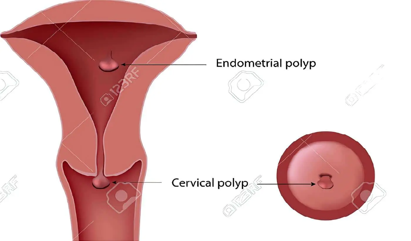 Pólipos Cervicales - Pólipos Endometriales