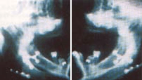 Radiografia lateral donde se aprecian la ausencia completa de maxilar (flechas)