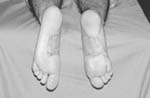 Seis meses postoperatorio, el paciente deambula con calzado normal