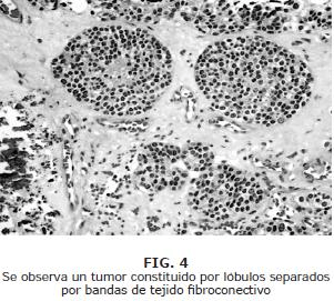  tumor constituido por lóbulos separados