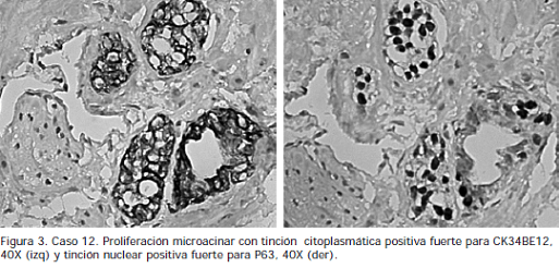 Proliferación microacinar con tinción