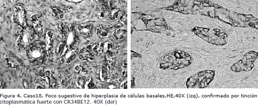 Proliferación microacinar con tinción