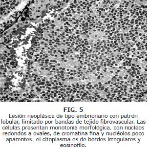 Lesión neoplásica de tipo embrionario con patrón