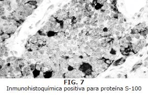  Inmunohistoquímica positiva para proteína S-100-1