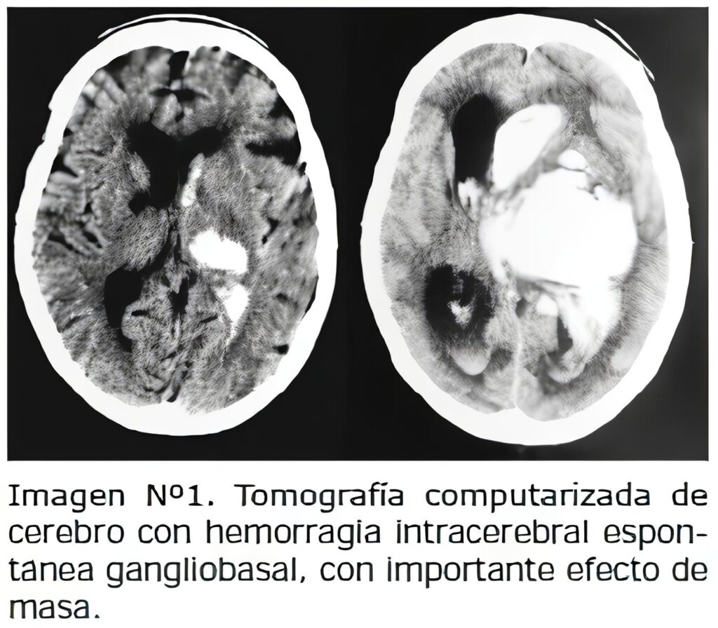 Tomografía computarizada, Hematoma Intracerebral